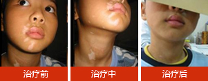 黑色素细胞培植疗法 治白癜风显奇效