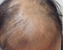 种不同脱发症状，毛囊是根源