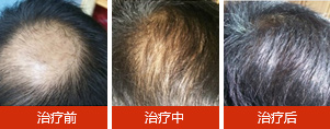 脱发四大危害 必须警惕