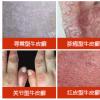 盘点：牛皮癣分型症状表现