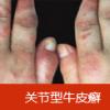警惕：牛皮癣严重可危及生命