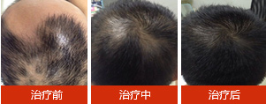 脱发治疗核心技术—中西医生物综合疗法