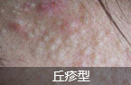 专家解析青春痘常见症状