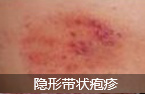 中西结合清毒免疫疗法 治疗带状疱疹的最佳技术