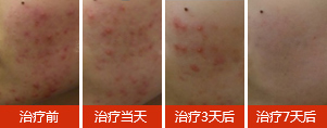 这样治，青春痘治愈率高达98.7%