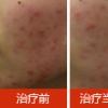 这样治，青春痘治愈率高达98.7%