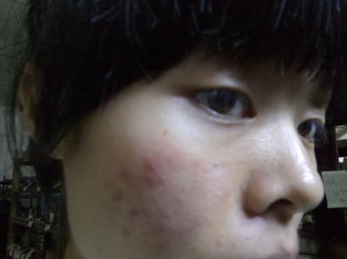 南京皮肤医院那里看青春痘好