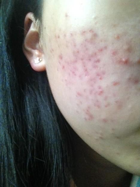 南京成年人易长青春痘的原因有那些