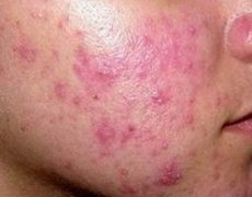治疗青春痘的食疗偏方_蒋王庙皮肤研究所