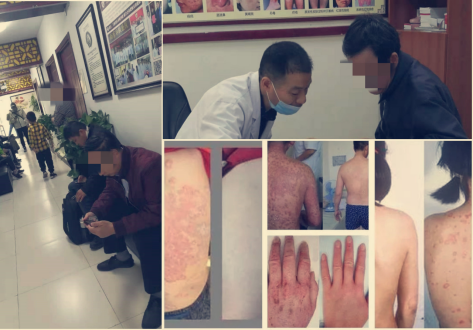 银屑病日华肤爱心门诊  患者踊跃报名